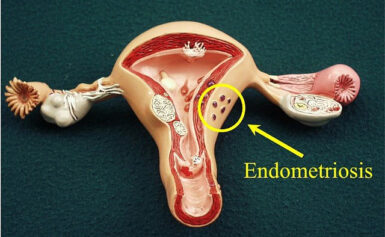 Az endometriózis tüneteinek leírása, ismertetése